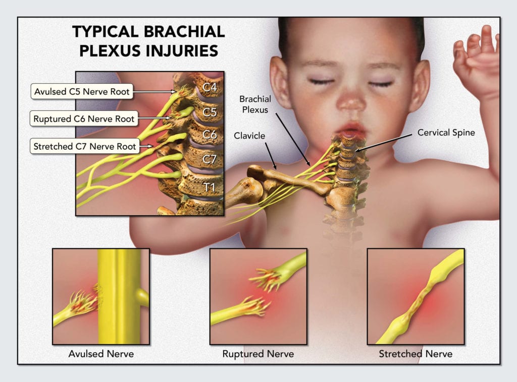 Severe cerebral palsy in adults