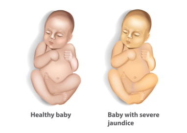 Normal pink skin of a healthy baby compared to the yellow skin of a baby with severe jaundice