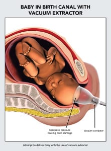 Illustration of a baby being delivered with a vacuum extractor using significant pressure which may lead to brain damage.