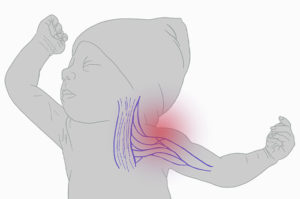 Illustration of a baby with nerve damage in their left arm.