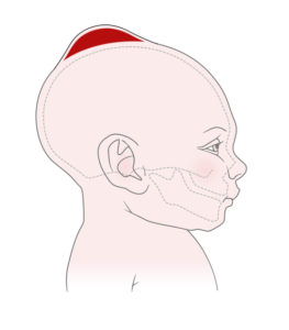 Illustration of a baby with a red bulge on the very top of their head