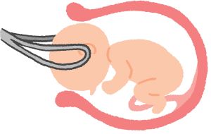 Illustration of a forceps delivery, showing the tool gently pulling a baby from the womb.