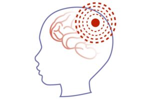 Profile of a child's head showing hypoxic ischemic encephalopathy symptoms on their brain.