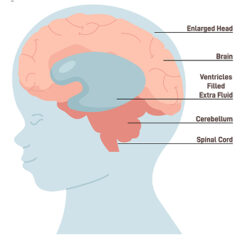 A medical illustration of a child with hydrocephalus, showing excess fluid in the brain’s ventricles and an enlarged head.