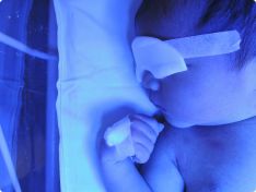 A newborn undergoing phototherapy for jaundice, a treatment that helps prevent kernicterus.