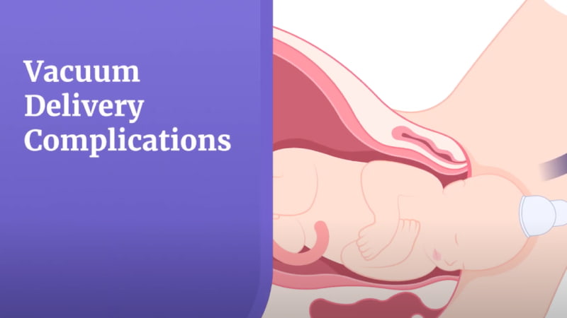 Birth Injuries Caused by Vacuum Extraction Complications